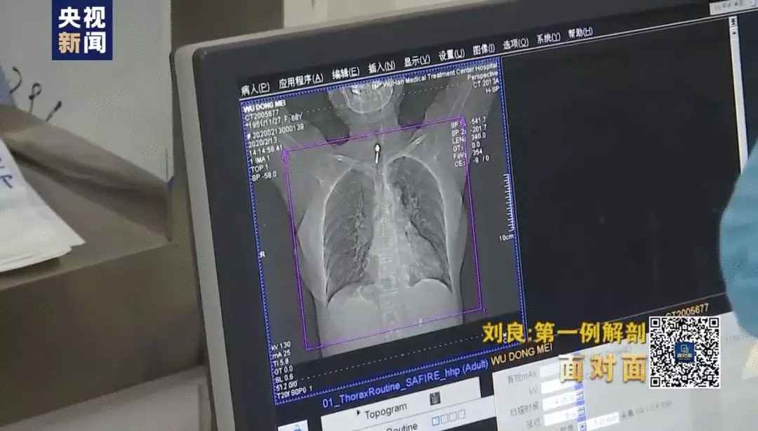 刘良还原新冠肺炎逝者解剖后的肺！新冠肺炎逝者的肺是什么样的有何不同