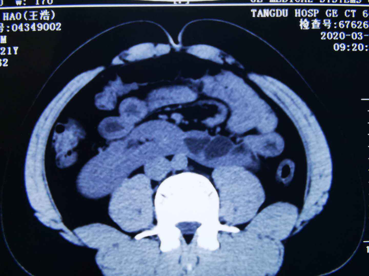 世界首例单切口经脐三角腹腔镜马蹄肾切除术在陕实施