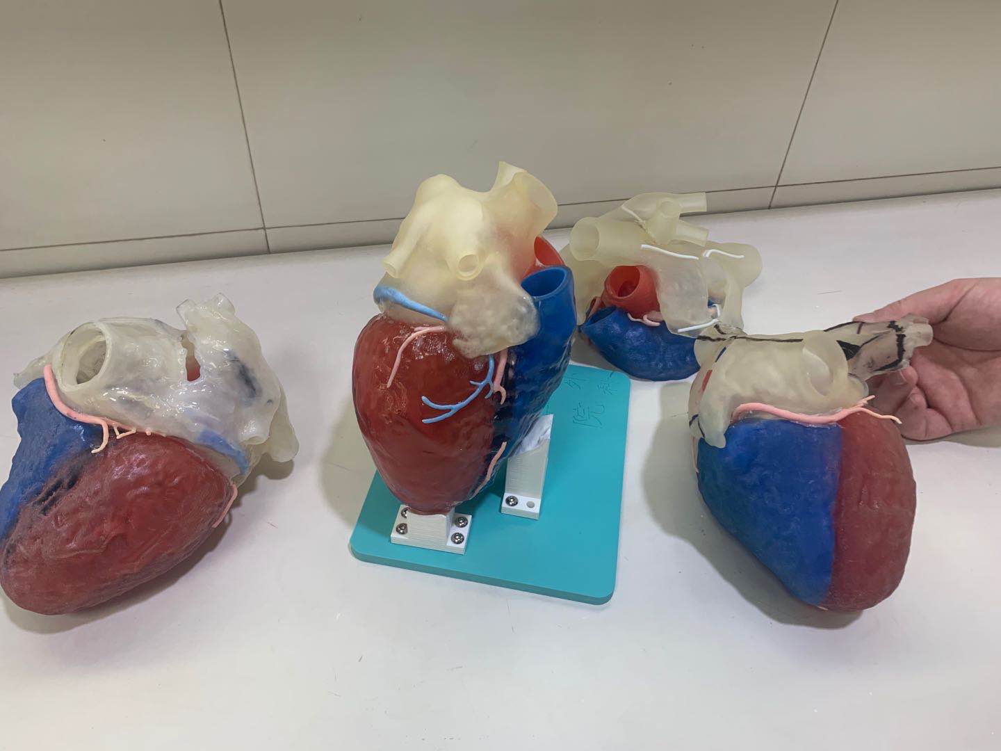 3D打印辅助，长沙成功实施全球首例“镜面人”心脏消融迷宫IV术