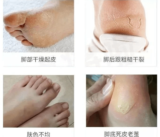 痛快“撕”脚皮,剥脱废弃角质,嫩肤滋养