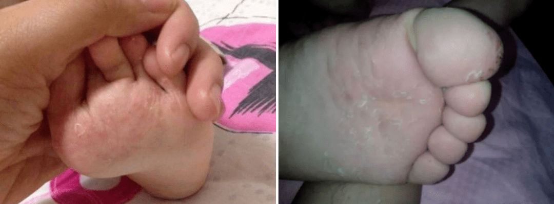 痛快“撕”脚皮,剥脱废弃角质,嫩肤滋养