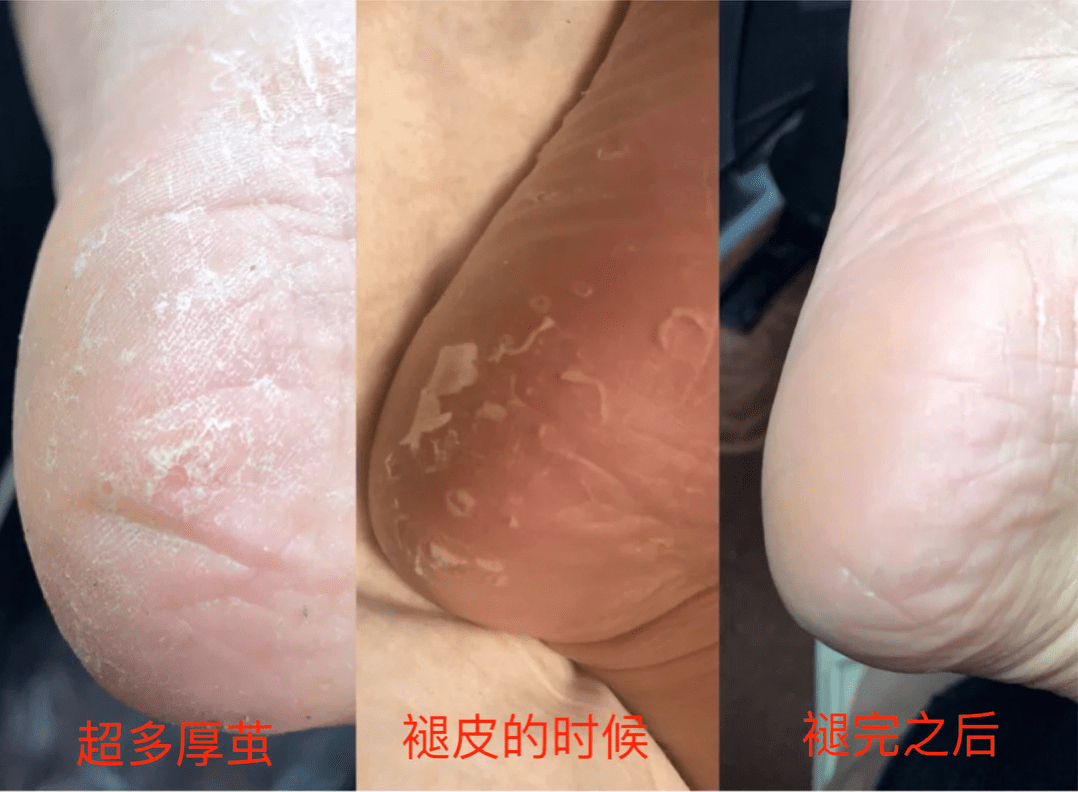 痛快“撕”脚皮,剥脱废弃角质,嫩肤滋养
