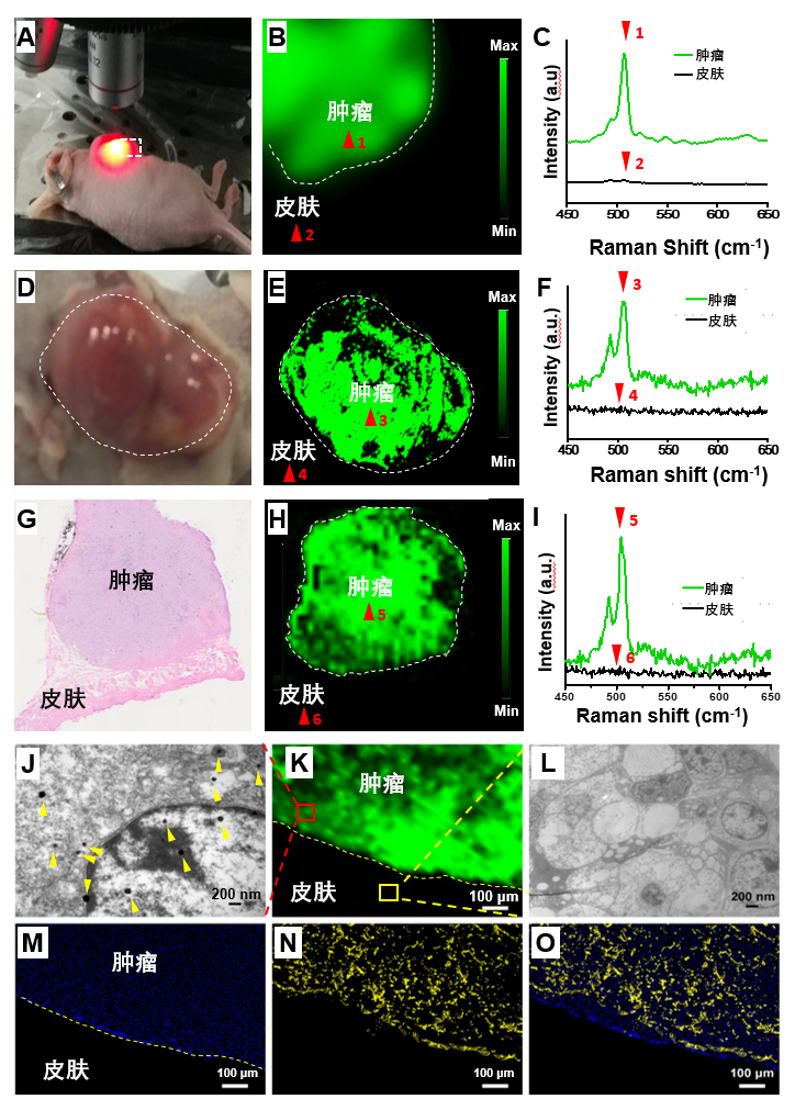 腹腔肿瘤体内转移扩散 拉曼探针开展精准“排雷”