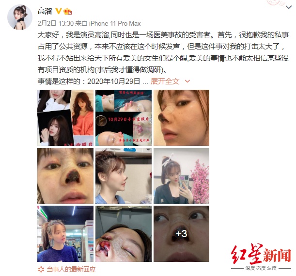演员高溜整容失败鼻尖坏死来龙去脉 涉事医美机构8个月曾遭5次行政处罚