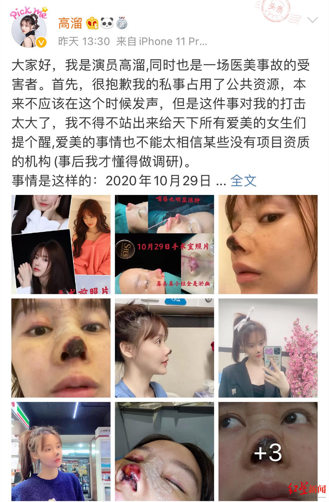演员高溜整容失败鼻尖坏死怎么回事 目前正在司法程序