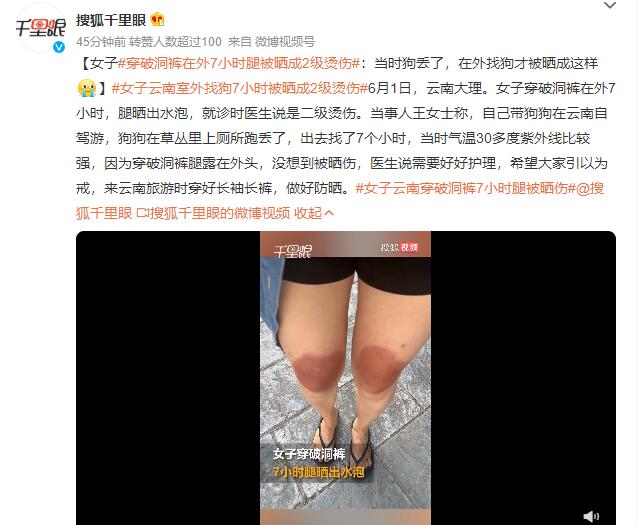 女子云南穿破洞裤7小时腿被晒伤 当时气温30多度紫外线比较强