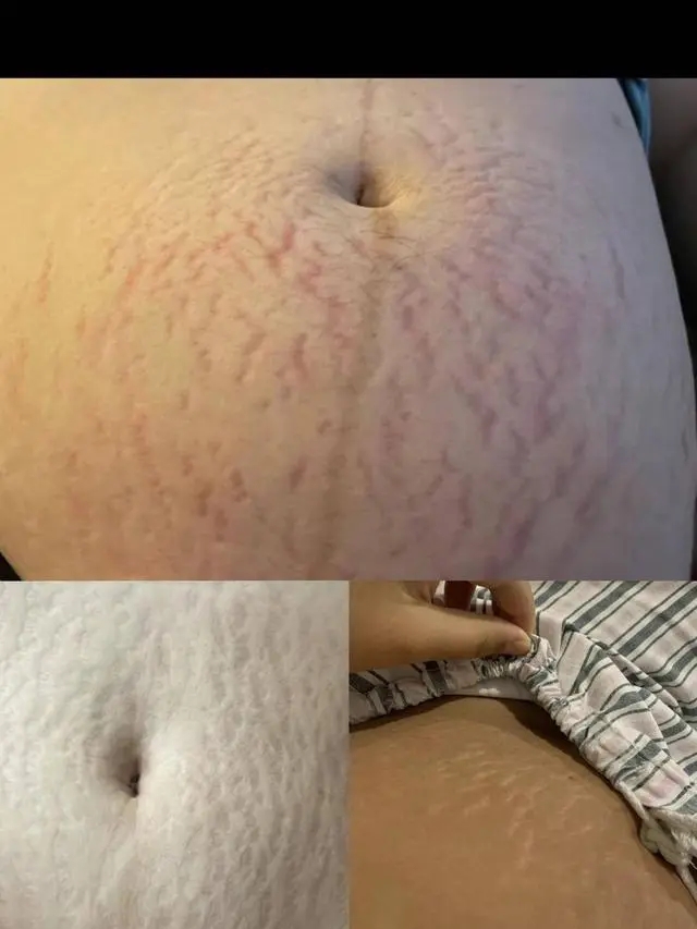 女性网友晒出肚皮上的妊娠纹